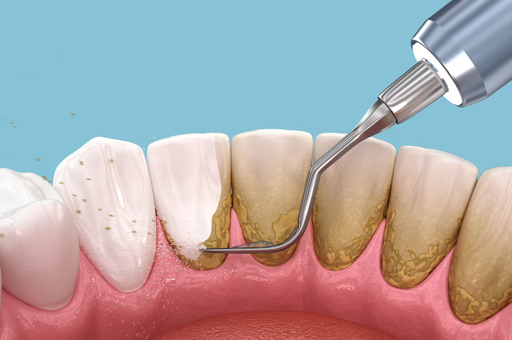 tartrectomia-periodoncia